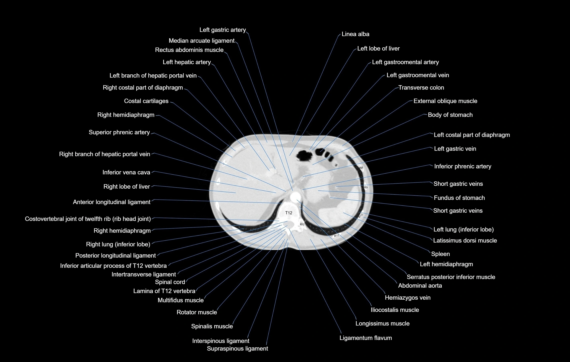 CT chest (thorax) labelled axial cross sectional anatomy radiology image-00113.webp